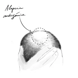 Alopecia androgénica masculina