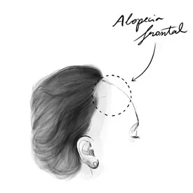 Alopecia frontal fibrosante