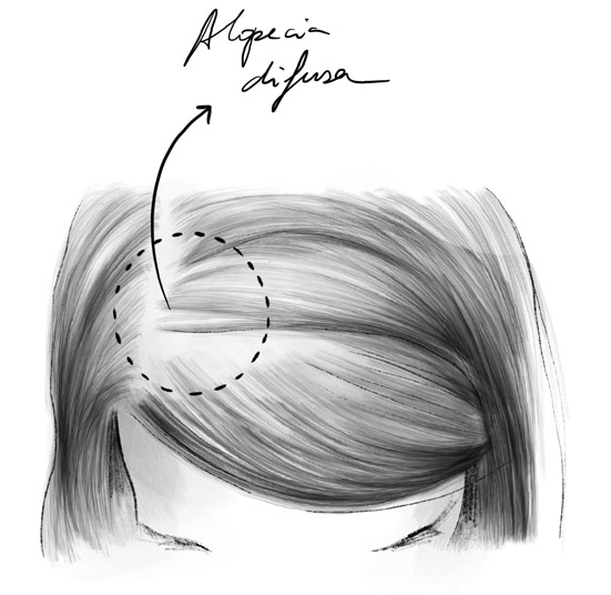 Causas de la pérdida de cabello y cómo prevenir la alopecia: una guía completa