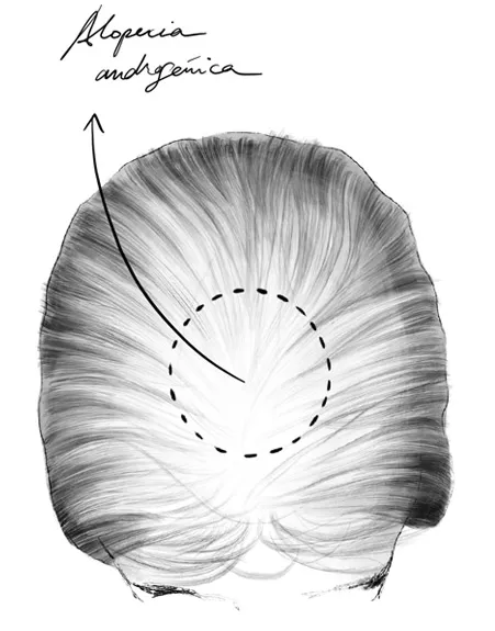 Alopecia androgénica femenina
